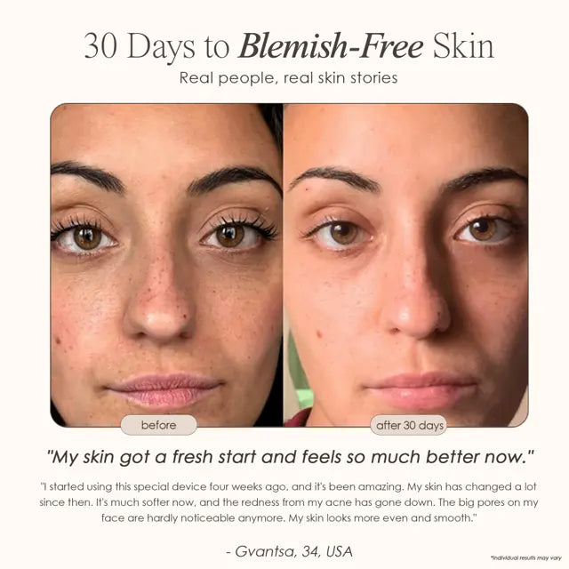 AquaGlow Blackhead Remover
