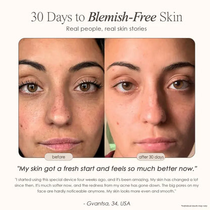 AquaGlow Blackhead Remover